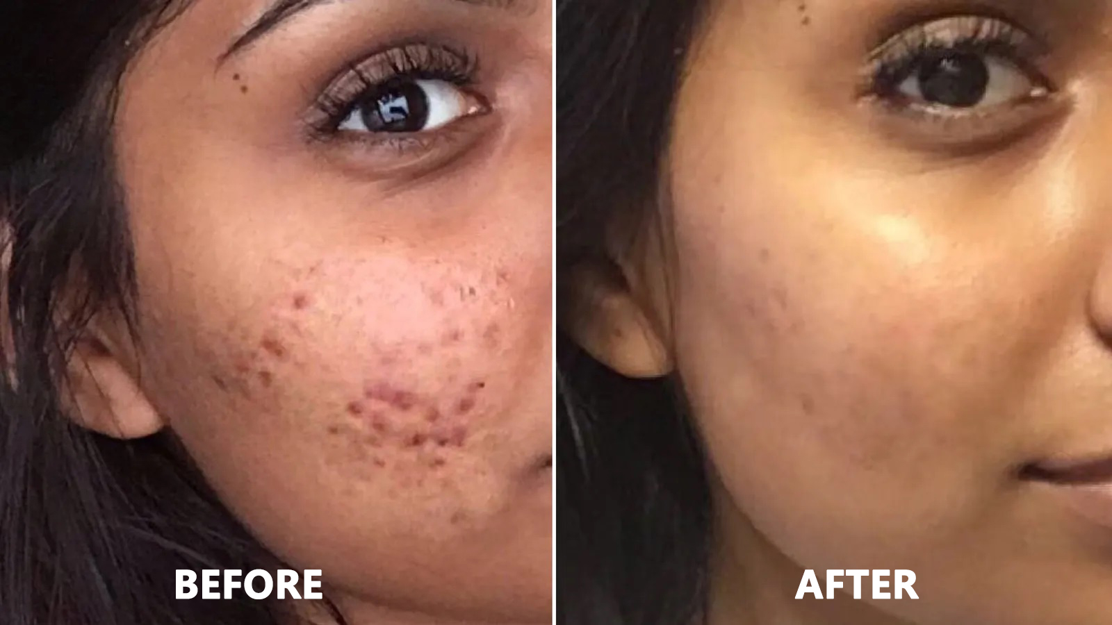 1663916501387999.jpg acne-routine-before-and-after1.jpg