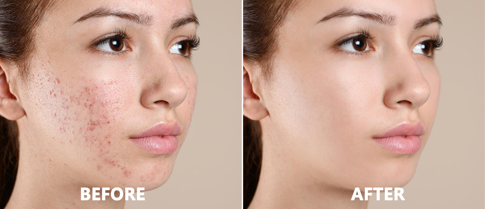 1663916532841534.jpg teenage-girl-acne-treatment-beige-background-1701069172.jpg